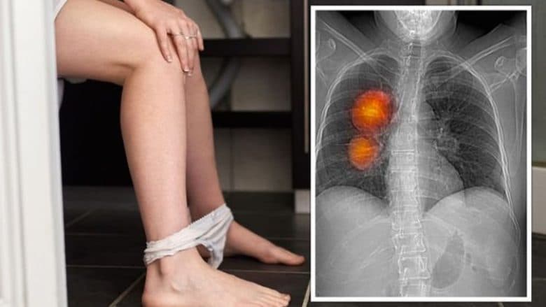 Shenja në urinën tuaj që paralajmëron se keni llojin më serioz të kancerit