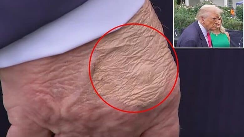 Disa shenja shfaqen në dorën e Trumpit, ekspertët zbulojnë se çfarë janë ato në të vërtetë