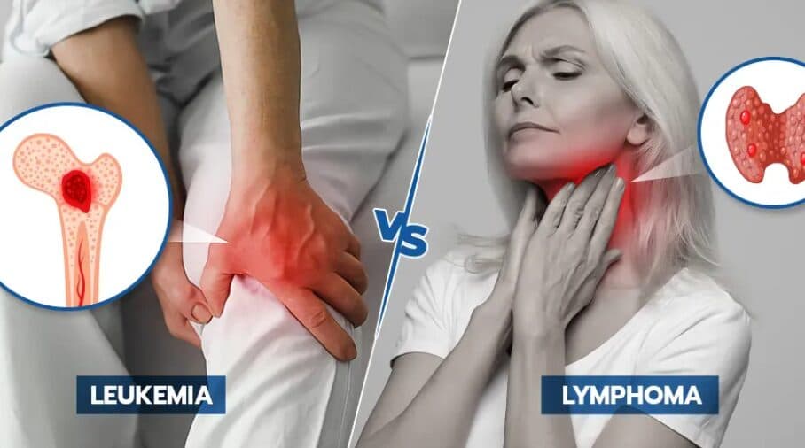 Leukemia dhe limfoma: Si dallojnë, simptomat dhe faktorët kryesorë të rrezikut