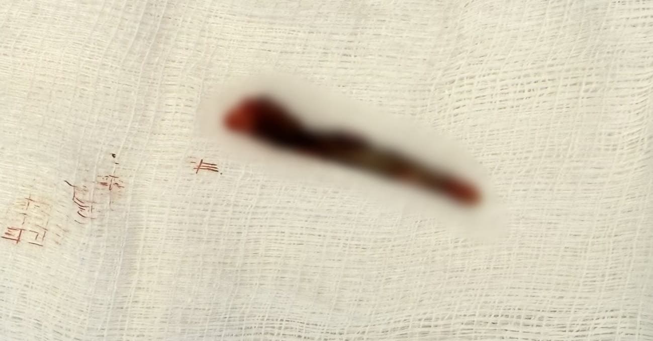 Realizohet për herë të parë një ndërhyrje kirurgjikale në Klinikën Vaskulare në QKUK