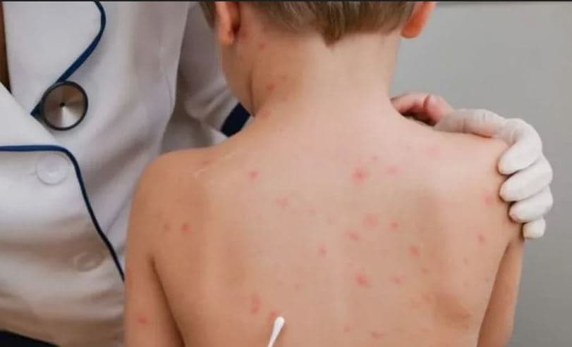Featured image for Foshnja njëvjeçare përfundon në spital me fruth në Kosovë, apel urgjent për vaksinimin e fëmijëve