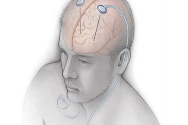 Sëmundja e Parkinsonit, metoda revolucionare: Grimcat magnetike riparojnë dëmtimin e trurit