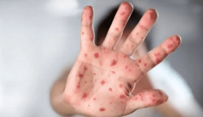 18 raste të reja me fruth gjatë javës së fundit, IKSHPK e rikujton se vaksinimi është masa e kryesore për parandalimin e tij