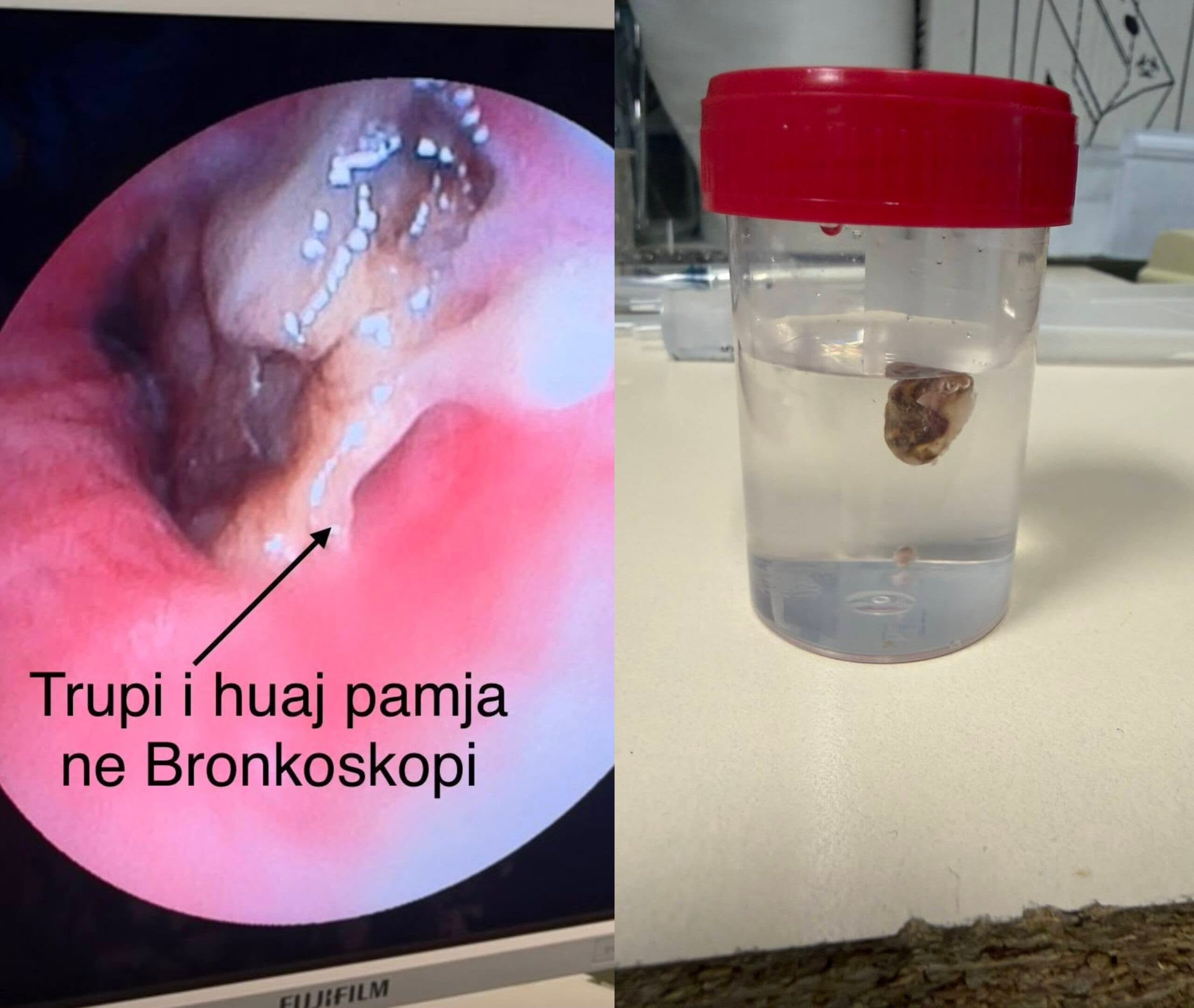 Ndërhyrje e suksesshme urgjente në Pulmologjinë e QKUK-së, i hiqet trup i huaj pacientes 63-vjeçare