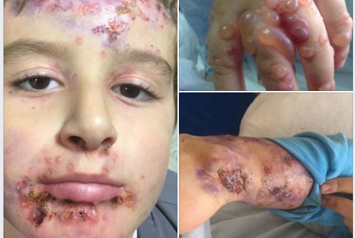 Ndihmë për vogëlushin nga Drenasi: 7 vjeçari vuan nga një sëmundje e rëndë, familja kërkon ndihmë (FOTO)